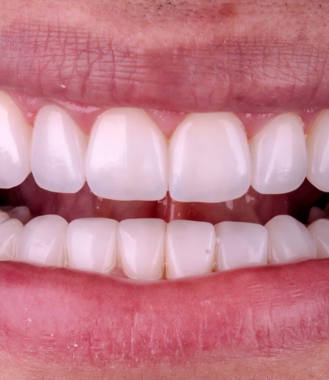 lente de contato dental